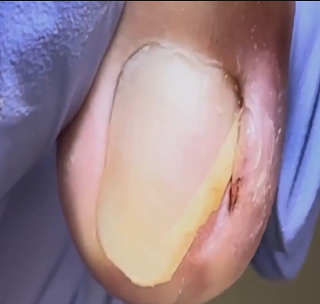 Poor thick onychomycosis, shaped like stairs【Pedicure King】