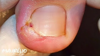 OVERGROWN INFECTED INGROWN TOENAIL REMOVAL ***WITH A SUPER SURPRISE***