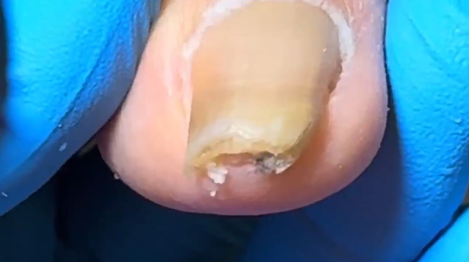 Transforming Thick Onychomycosis Toenails: The Staircase Pedicure Technique