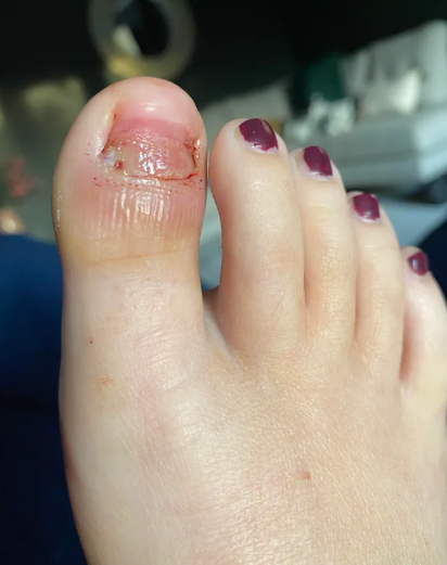 The Toenail Chronicles