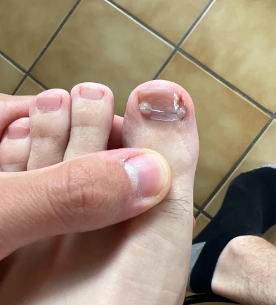 Battle of the Toenails